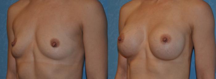 Before & After Breast Augmentation Case 310 View #3 View in Toledo, Ohio