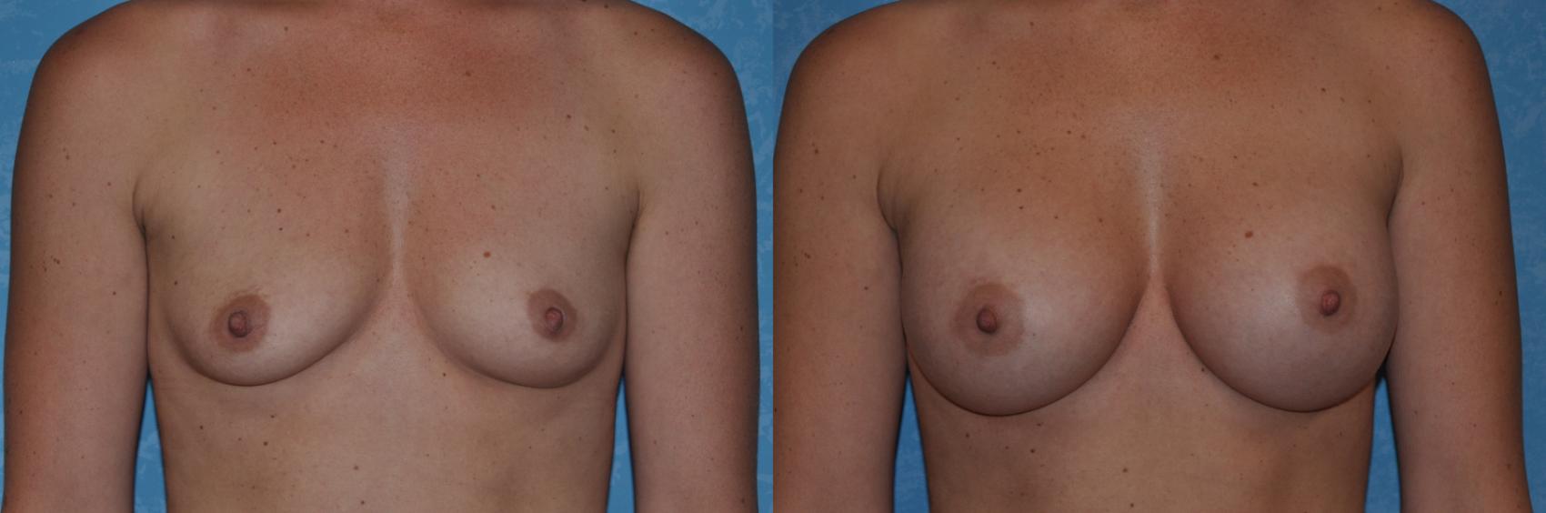 Before & After Breast Augmentation Case 311 View #1 View in Toledo, Ohio