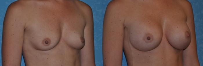 Before & After Breast Augmentation Case 311 View #2 View in Toledo, Ohio