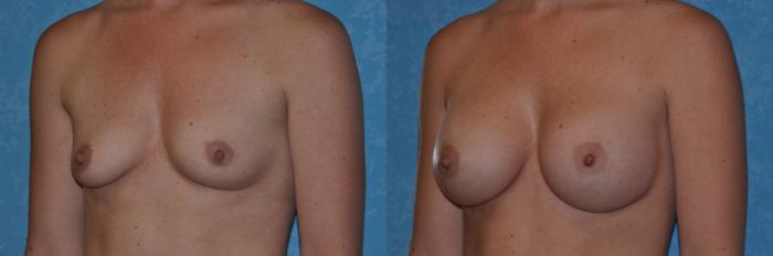 Before & After Breast Augmentation Case 311 View #3 View in Toledo, Ohio