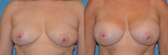Before & After Breast Augmentation Case 312 View #1 View in Toledo, Ohio