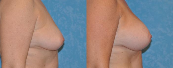 Before & After Breast Augmentation Case 312 View #2 View in Toledo, Ohio