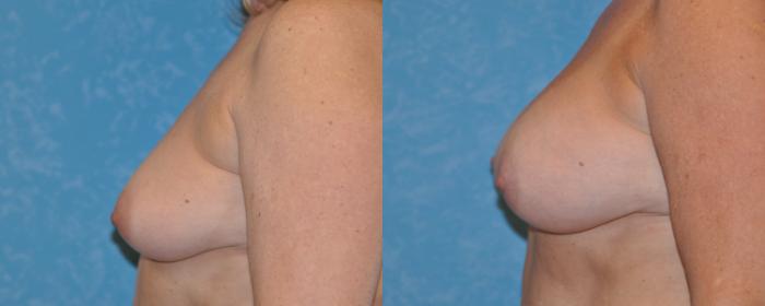 Before & After Breast Augmentation Case 312 View #3 View in Toledo, Ohio