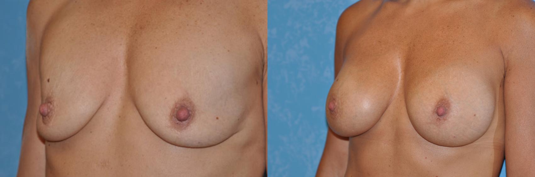 Before & After Breast Augmentation Case 32 View #1 View in Toledo, Ohio
