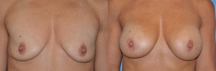 Before & After Breast Augmentation Case 32 View #2 View in Toledo, Ohio