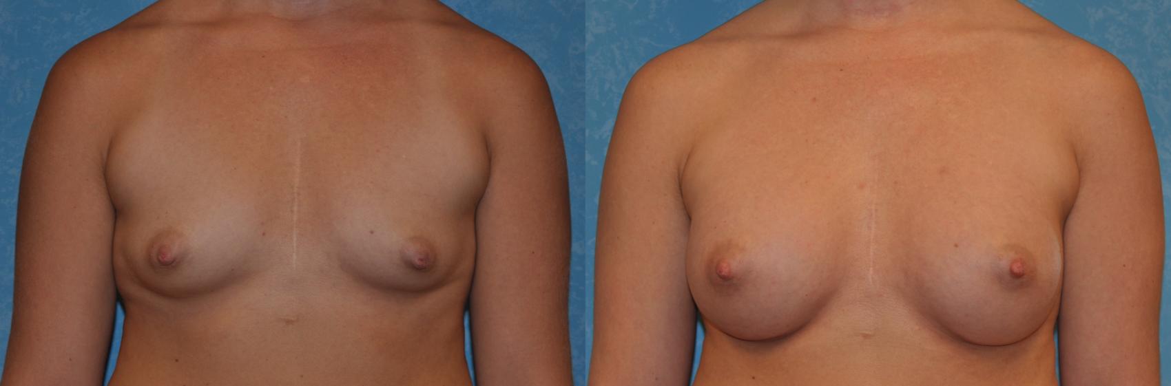 Before & After Breast Augmentation Case 320 View #1 View in Toledo, Ohio