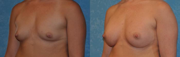 Before & After Breast Augmentation Case 320 View #2 View in Toledo, Ohio