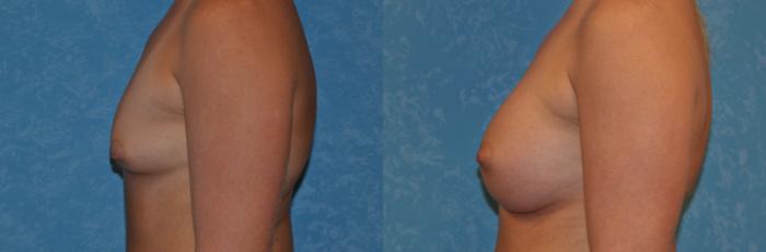 Before & After Breast Augmentation Case 320 View #3 View in Toledo, Ohio