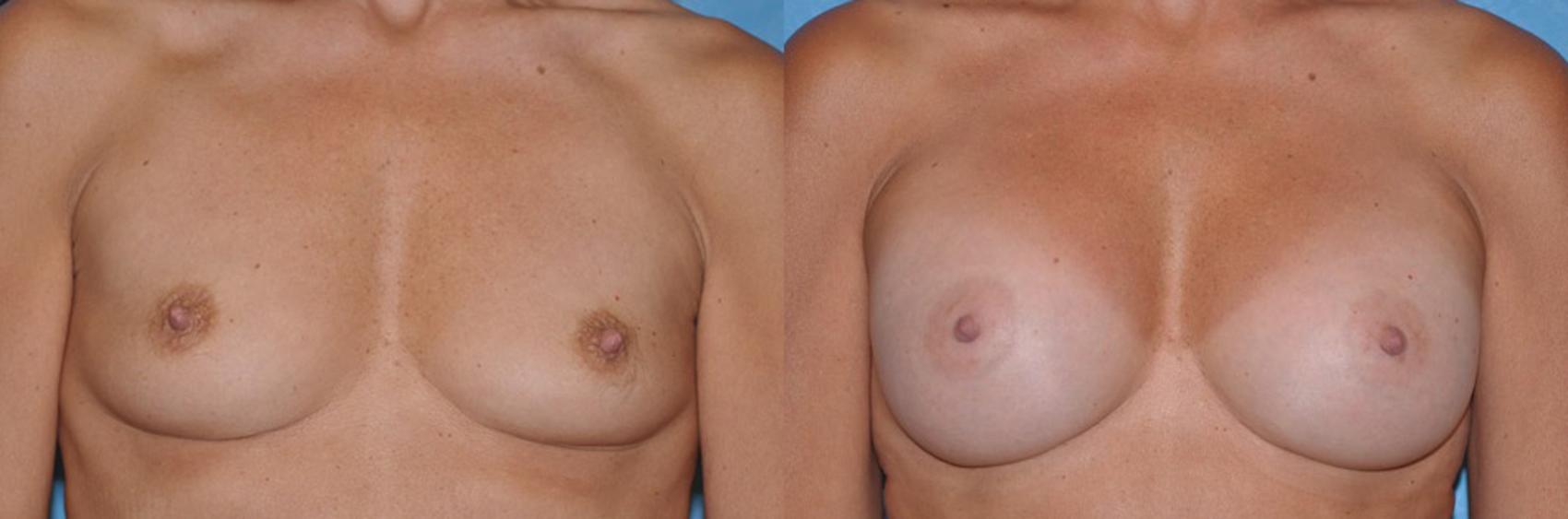 Before & After Breast Augmentation Case 33 View #1 View in Toledo, Ohio