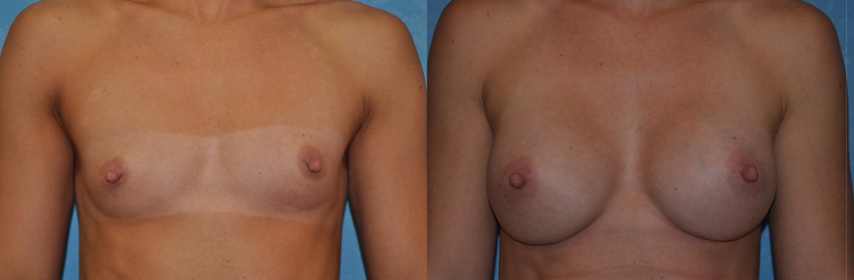 Before & After Breast Augmentation Case 332 View #1 View in Toledo, Ohio