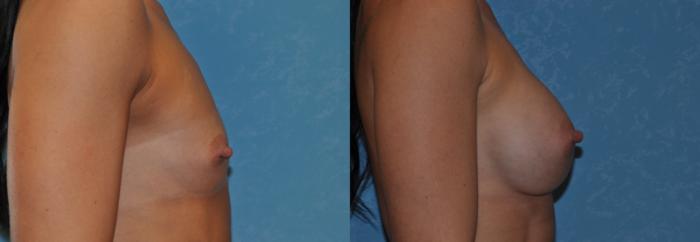 Before & After Breast Augmentation Case 332 View #2 View in Toledo, Ohio