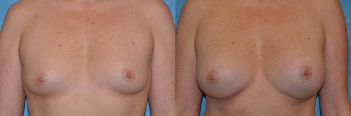 Before & After Breast Augmentation Case 333 View #1 View in Toledo, Ohio