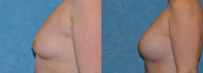 Before & After Breast Augmentation Case 333 View #3 View in Toledo, Ohio