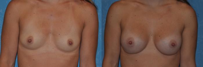 Before & After Breast Augmentation Case 336 View #1 View in Toledo, Ohio