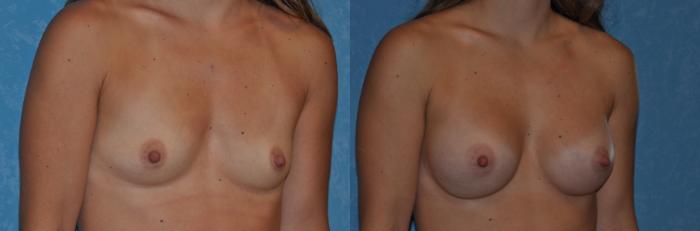 Before & After Breast Augmentation Case 336 View #2 View in Toledo, Ohio