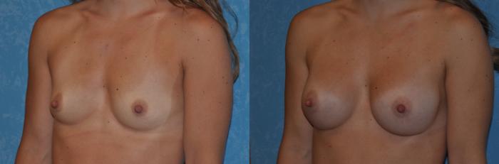 Before & After Breast Augmentation Case 336 View #3 View in Toledo, Ohio