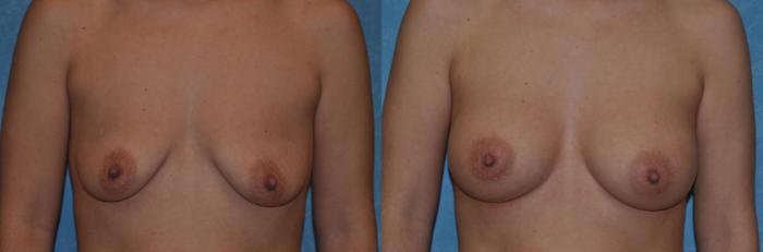 Before & After Breast Augmentation Case 337 View #1 View in Toledo, Ohio