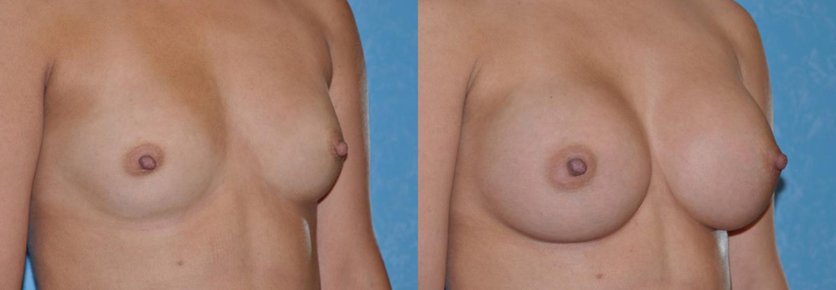 Before & After Breast Augmentation Case 34 View #1 View in Toledo, Ohio