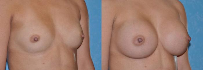 Before & After Breast Augmentation Case 34 View #1 View in Toledo, Ohio