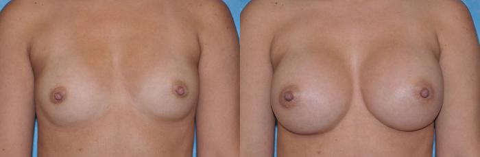 Before & After Breast Augmentation Case 34 View #2 View in Toledo, Ohio