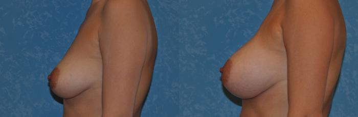 Before & After Breast Augmentation Case 341 View #2 View in Toledo, Ohio