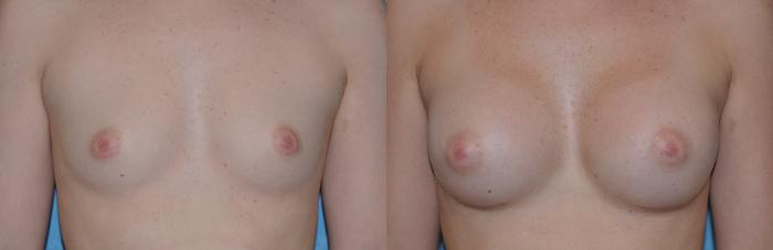 Before & After Breast Augmentation Case 35 View #1 View in Toledo, Ohio