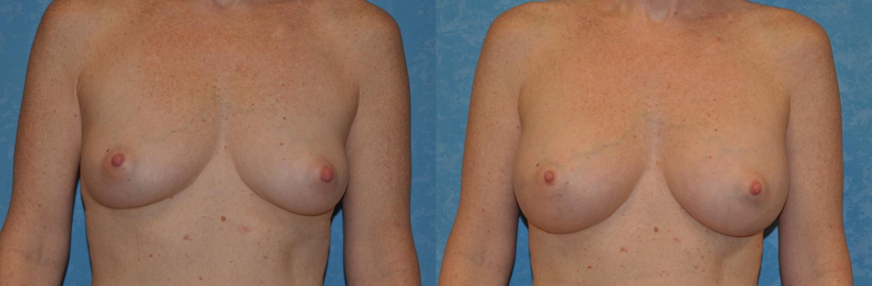 Before & After Breast Augmentation Case 360 View #1 View in Toledo, Ohio