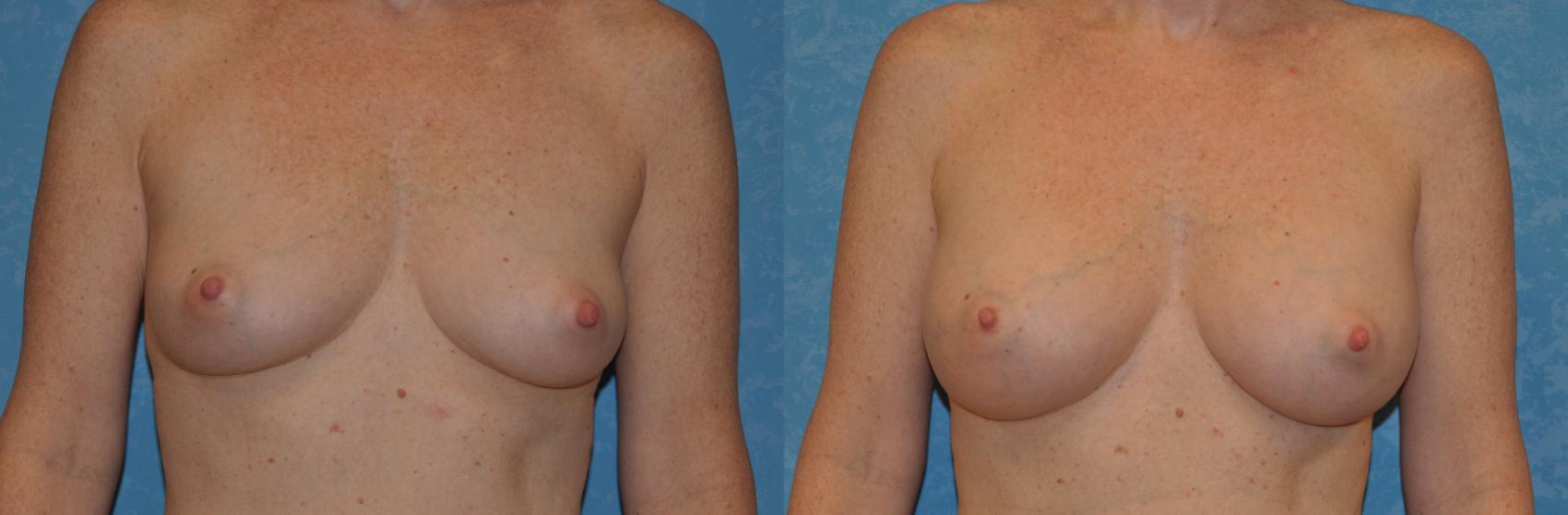 Rapid Recovery Breast Augmentation Toledo Findlay Ohio Dr