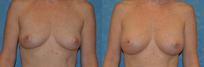 Before & After Breast Augmentation Case 360 View #1 View in Toledo, Ohio