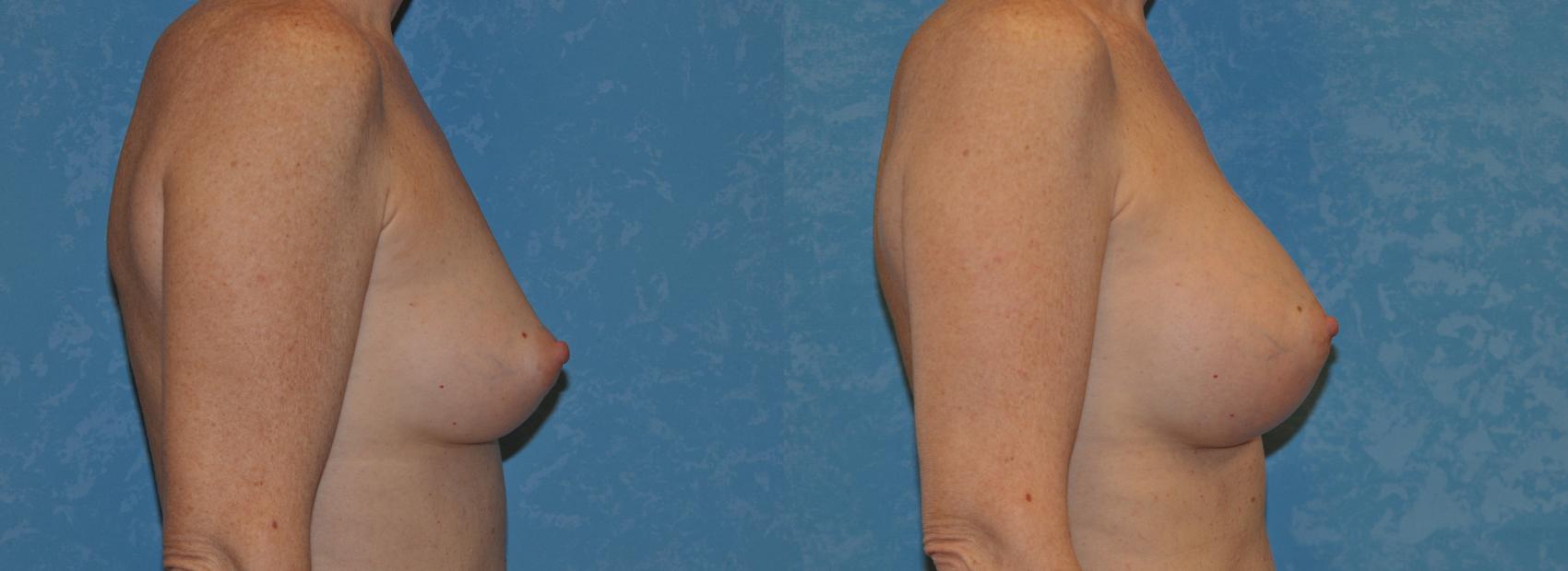 Before & After Breast Augmentation Case 360 View #2 View in Toledo, Ohio