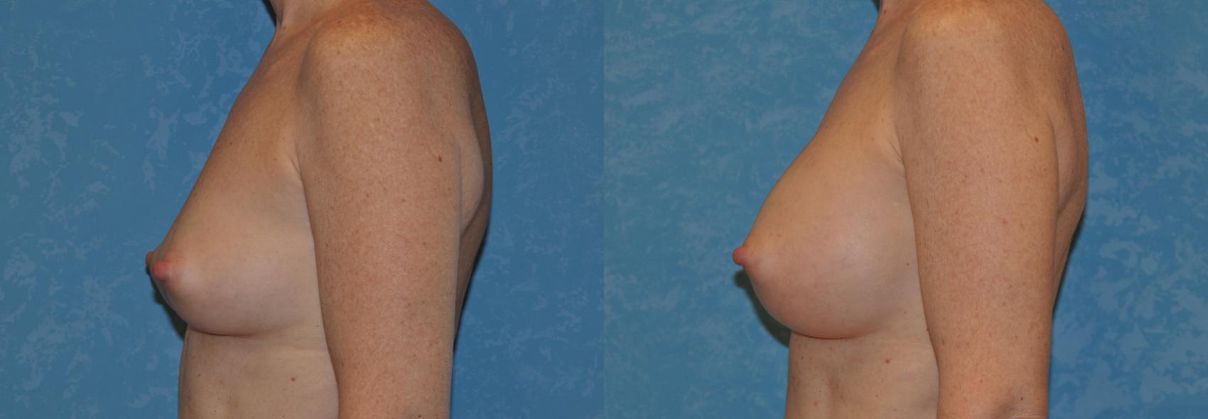 Before & After Breast Augmentation Case 360 View #3 View in Toledo, Ohio