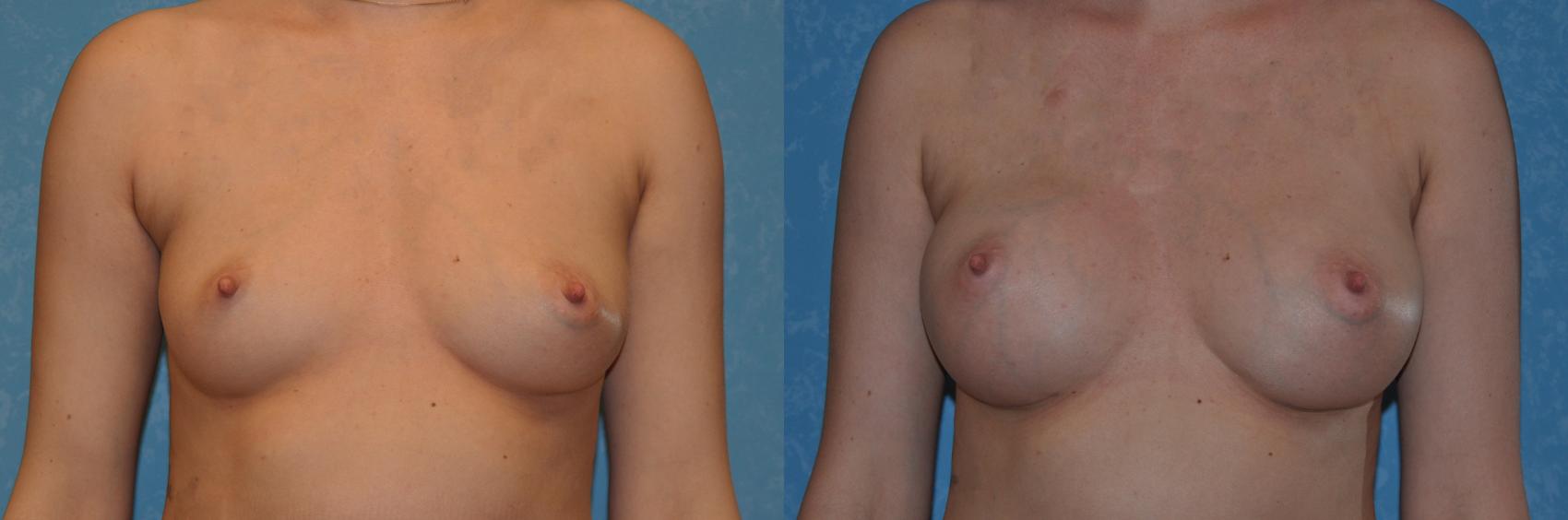 Before & After Breast Augmentation Case 382 View #1 View in Toledo, Ohio