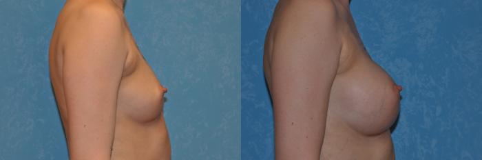 Before & After Breast Augmentation Case 382 View #2 View in Toledo, Ohio