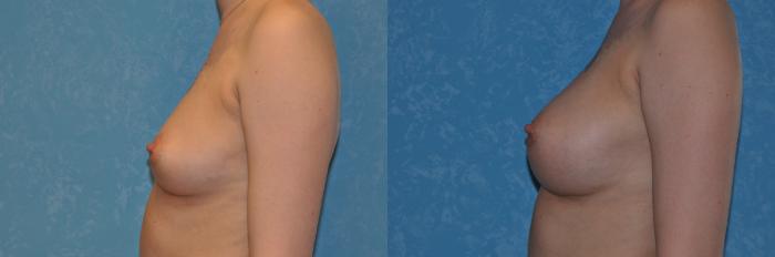 Before & After Breast Augmentation Case 382 View #3 View in Toledo, Ohio