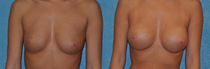 Before & After Breast Augmentation Case 385 View #1 View in Toledo, Ohio