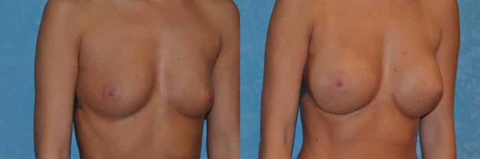 Before & After Breast Augmentation Case 385 View #2 View in Toledo, Ohio