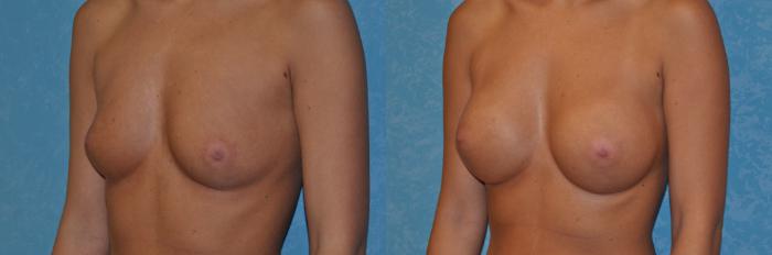 Before & After Breast Augmentation Case 385 View #3 View in Toledo, Ohio
