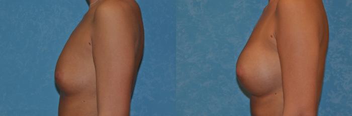 Before & After Breast Augmentation Case 385 View #5 View in Toledo, Ohio