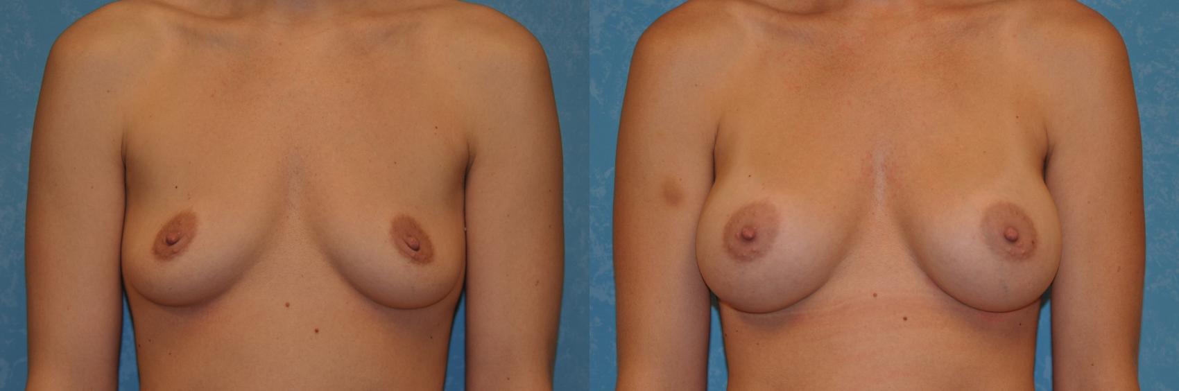 Before & After Breast Augmentation Case 389 Front View in Toledo, Ohio