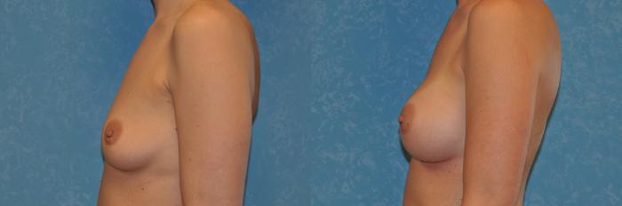Before & After Breast Augmentation Case 389 Left Side View in Toledo, Ohio