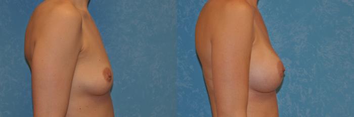 Before & After Breast Augmentation Case 389 Right Side View in Toledo, Ohio