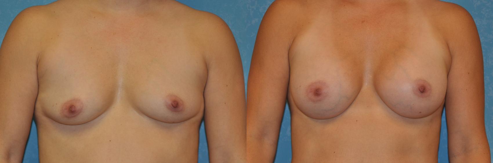 Before & After Breast Augmentation Case 392 Front View in Toledo, Ohio