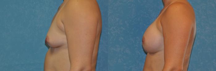 Before & After Breast Augmentation Case 392 Left Side View in Toledo, Ohio