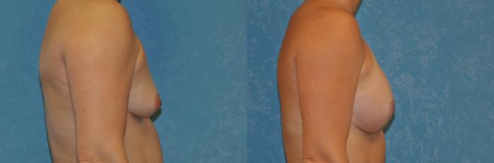 Before & After Breast Augmentation Case 392 Right Side View in Toledo, Ohio