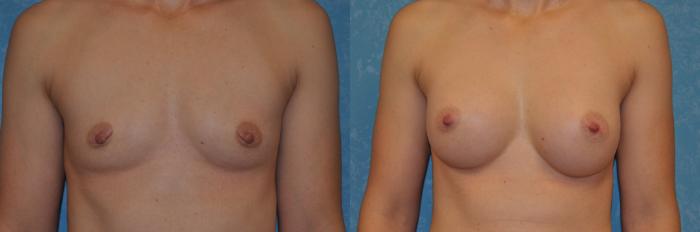 Before & After Breast Augmentation Case 395 Front View in Toledo, Ohio