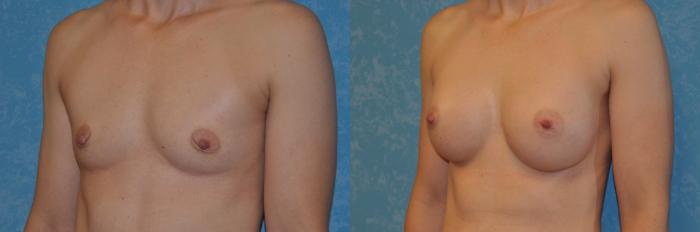 Before & After Breast Augmentation Case 395 Left Oblique View in Toledo, Ohio