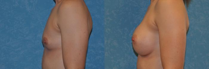 Before & After Breast Augmentation Case 395 Left Side View in Toledo, Ohio