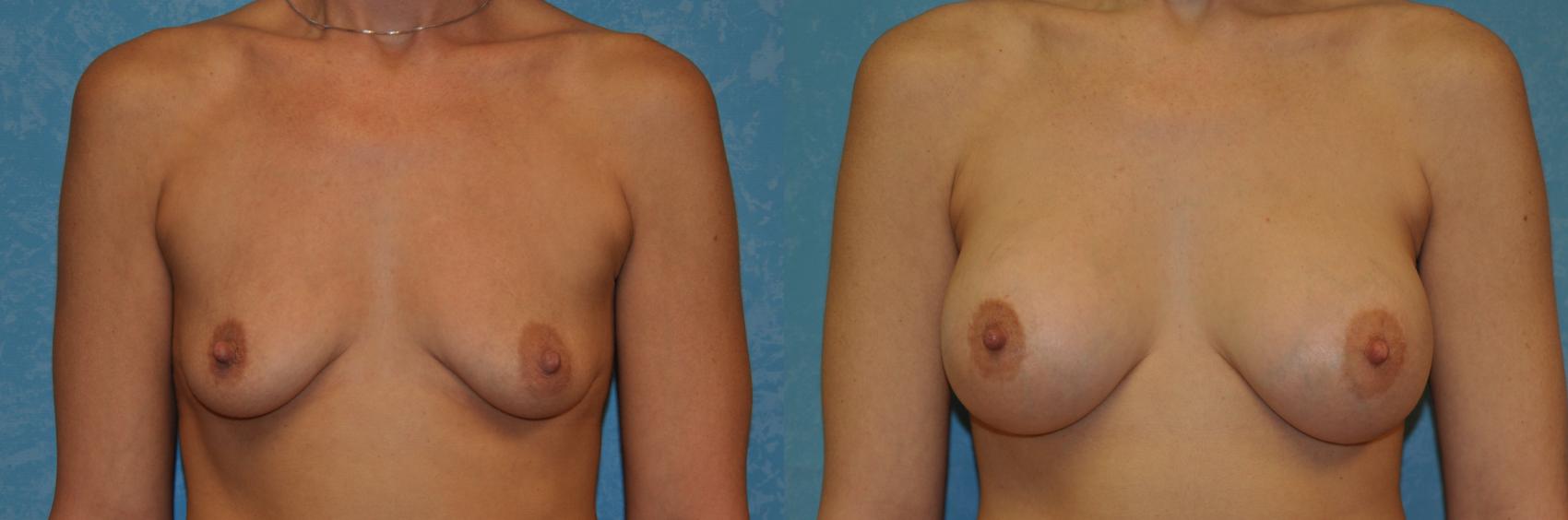 Before & After Breast Augmentation Case 400 Front View in Toledo, Ohio