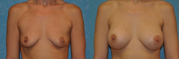 Before & After Breast Augmentation Case 400 Front View in Toledo, Ohio