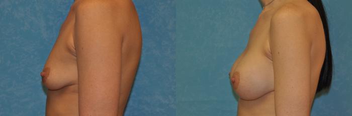 Before & After Breast Augmentation Case 400 Left Side View in Toledo, Ohio